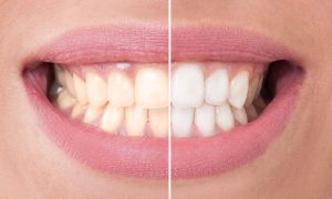 before and after teeth whitening treatment